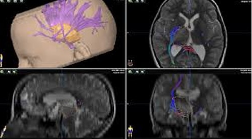neuronavigation-tratment-service-500x500